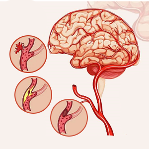 Rối loạn tiền đình trung ương